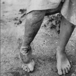 lepers-foot