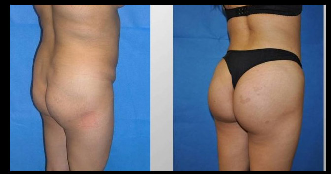 buttock implants before and after. His gallery of Buttock